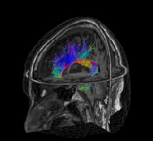 3D MRT scan des Kopfes