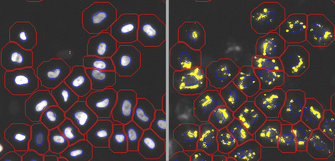 Mikroskopische Bilder menschlicher Neuroblastomzellen. Links: Zellkerne (blaue) und Zellmembran (rote Konturlinien). Rechts: Fluoreszenzmarkierte Aβ-Ablagerungen (gelb)