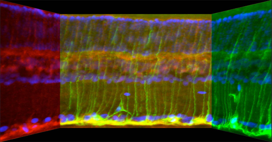 Abb.3: Querschnitt durch eine Retina Abb.3: Querschnitt durch eine Retina: Die Expression von CNTF (rot) in retinalen Astrozyten und Müllerzellen (grün) wird durch eine Linsenverletzung deutlich hochreguliert. Zellkerne von retinalen Zellen sind blau gefärbt.