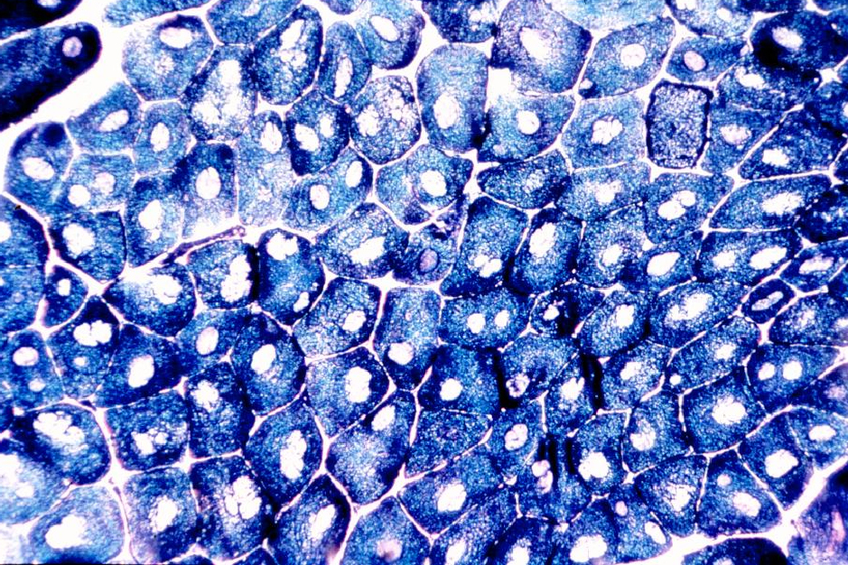 NADH-Reduktase-Färbung des Muskelquerschnitts von einem Patienten mit Central-Core Myopathie. Beachte die zentral in den Muskelfasern gelegenen Cores, in denen die Mitochondria fehlen (Vergrößerung 400x).
