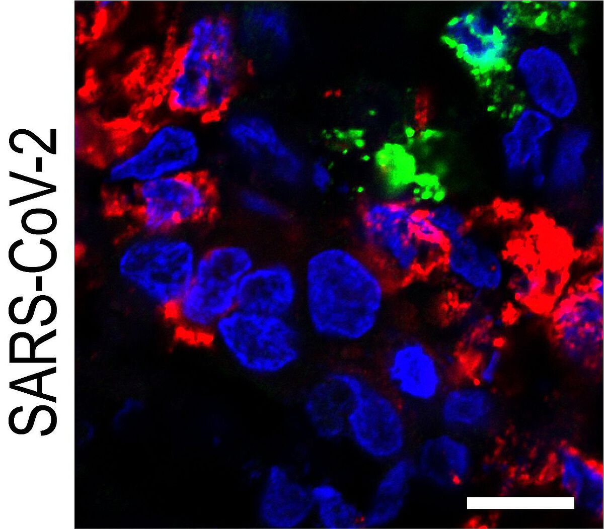 Fluoreszenzmikroskopische Aufnahmen (Merge) von SARS-CoV-2-infizierten Beta-Zellen 