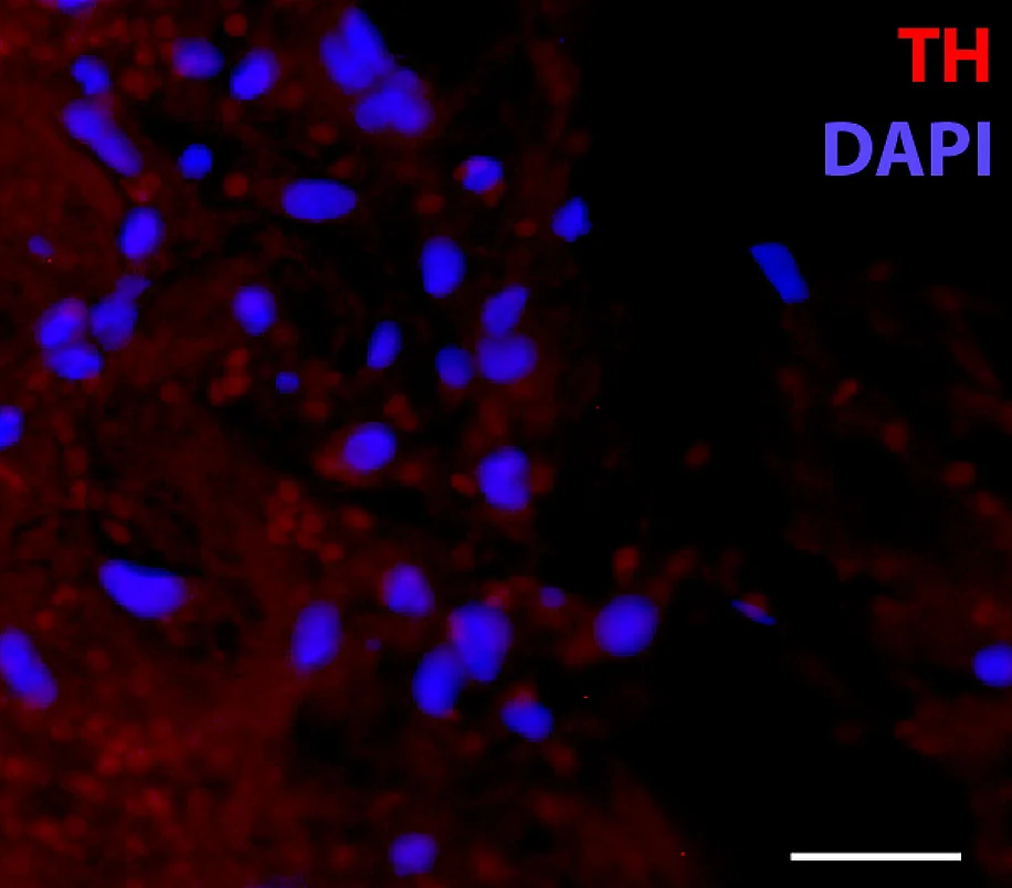 Expression des Enzyms Thyrosinhydroxylase (TH) im humanen Frakturhämatom
