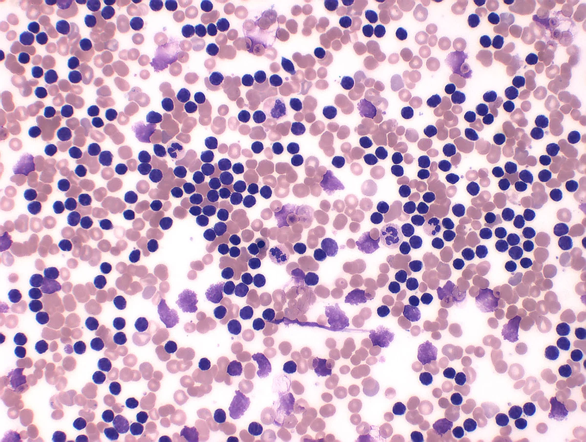 Blutausstrich eines Patienten mit Chronisch Lymphatischer Leukämie (CLL)