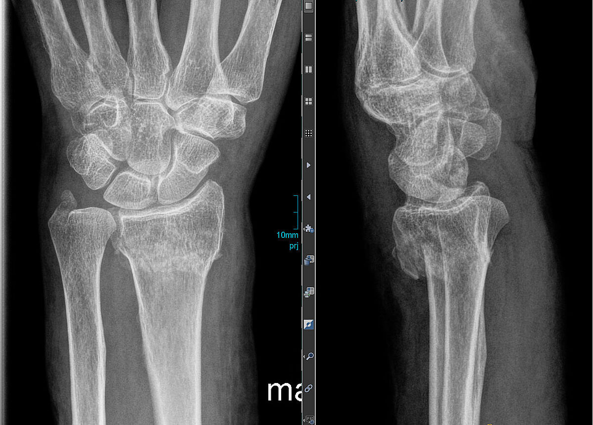 Röntgenaufnahmen einer Unterarmfraktur 