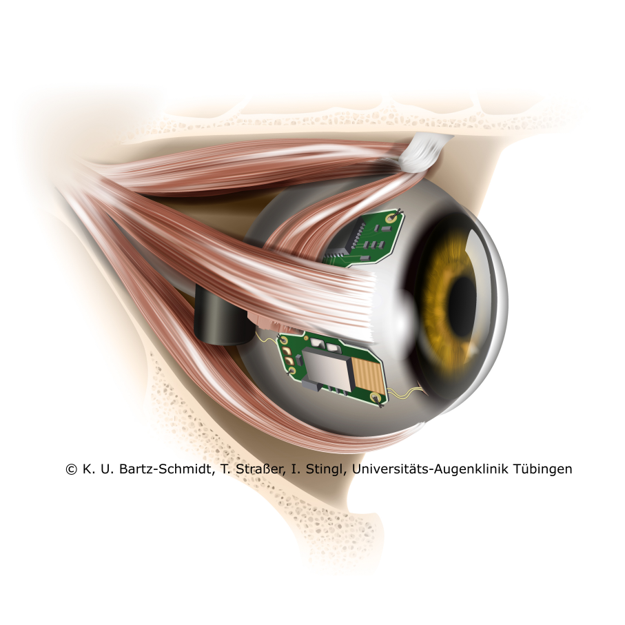 Implanted intraocular sensor for ciliary muscle potentials