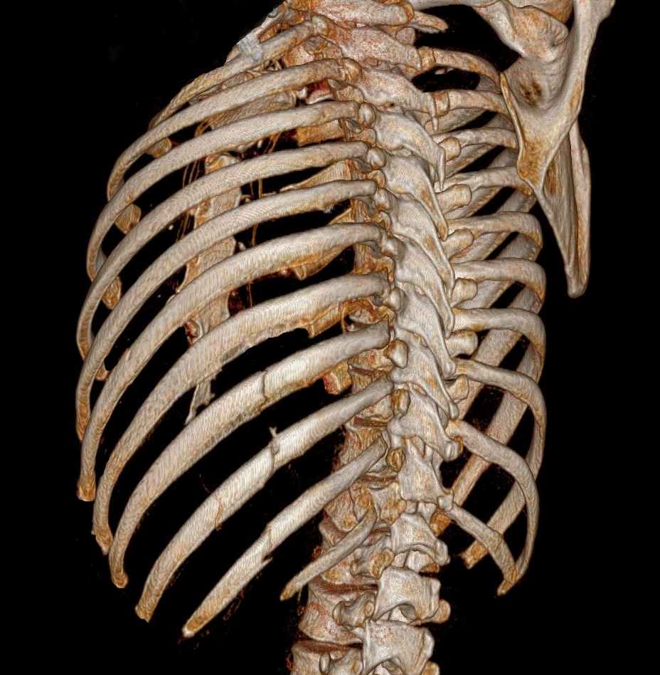 Computer-Rekonstruktion eines Brustkorbs mit Rippenserienfraktur mt Hilfe von CT-Daten
