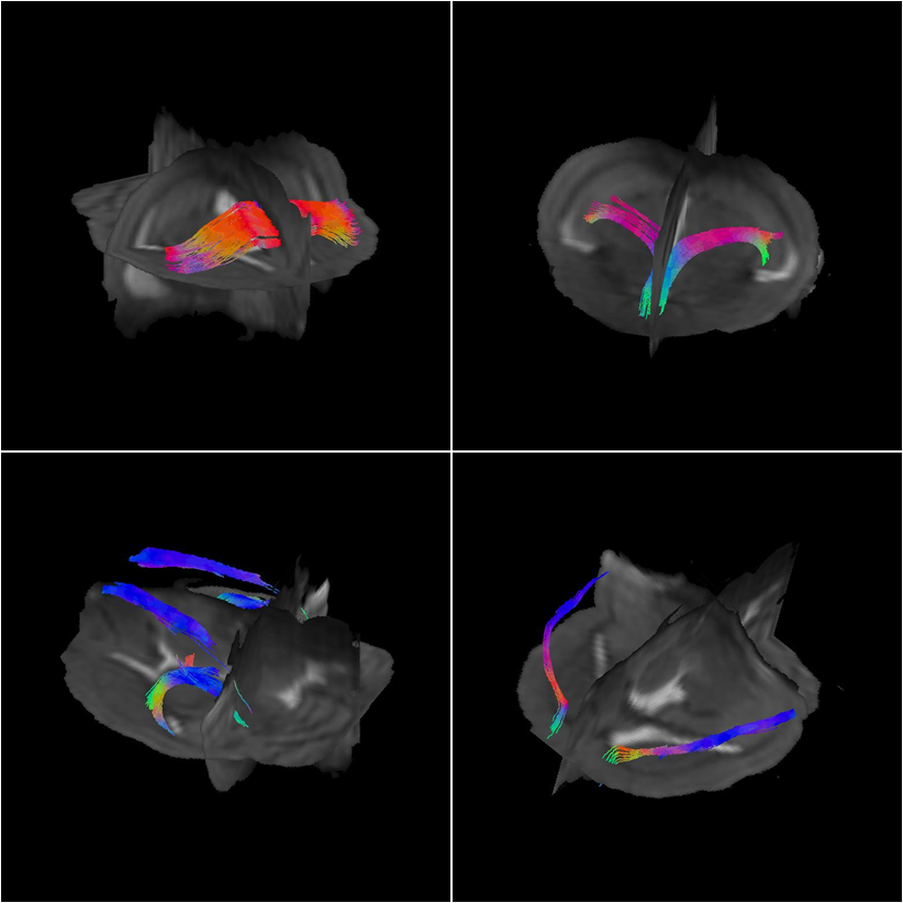 Functional MRI with DTI Fiber Tracking Picture of functional MRI with DTI Fiber Tracking