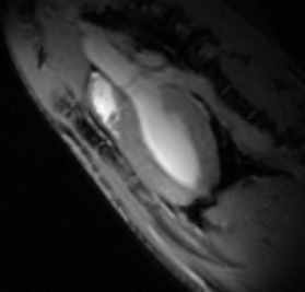 Long axis view of 2-chamber cardiac inaging