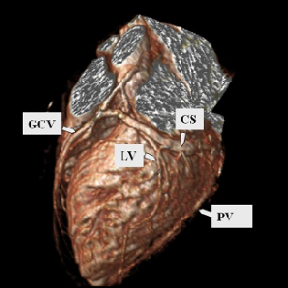 3D-MRT scan des Herzens