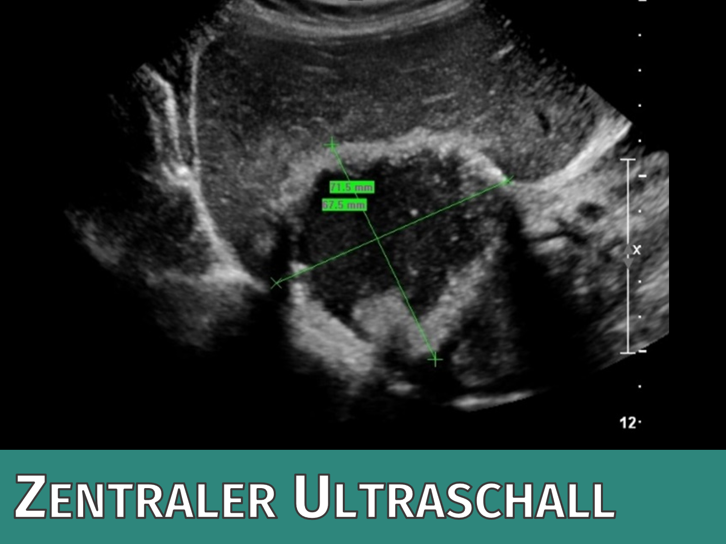 Zentraler Ultraschall