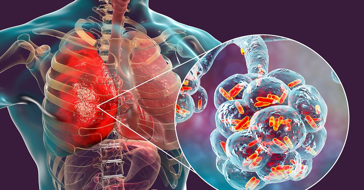 Pneumonia