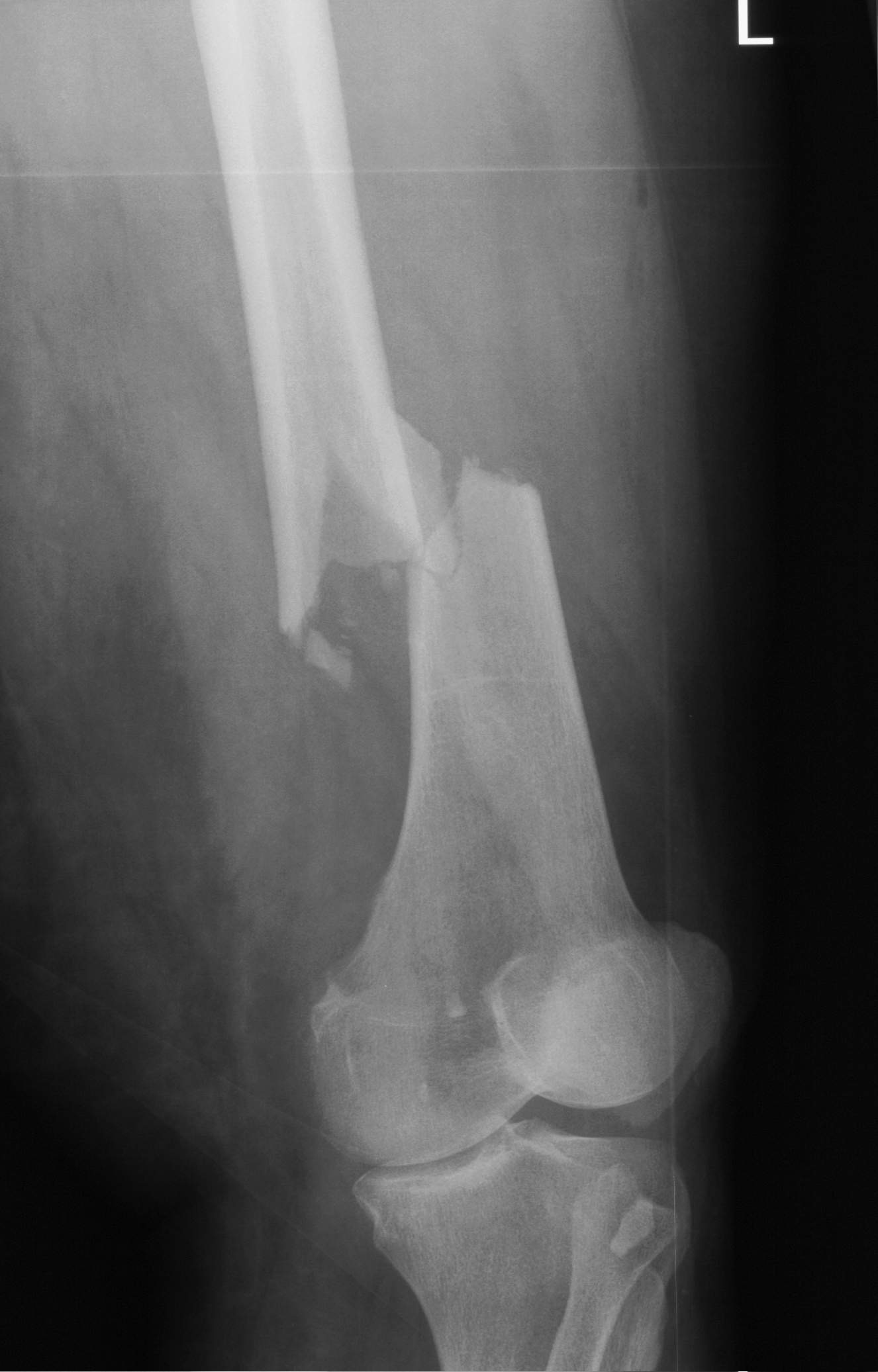 Röntgenaufnahme eines Oberschenkelbruchs